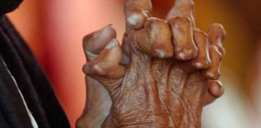 नेपालका १६ जिल्ला कुष्ठरोग मुक्त हुन बाँकी