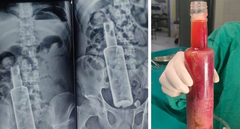 पेटभित्र रक्सीको बोतल भेटिएका युवक अस्पतालबाट डिस्चार्ज