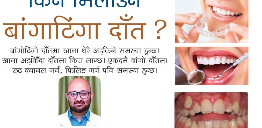 किन मिलाउने बांगोटिंगो दाँत?