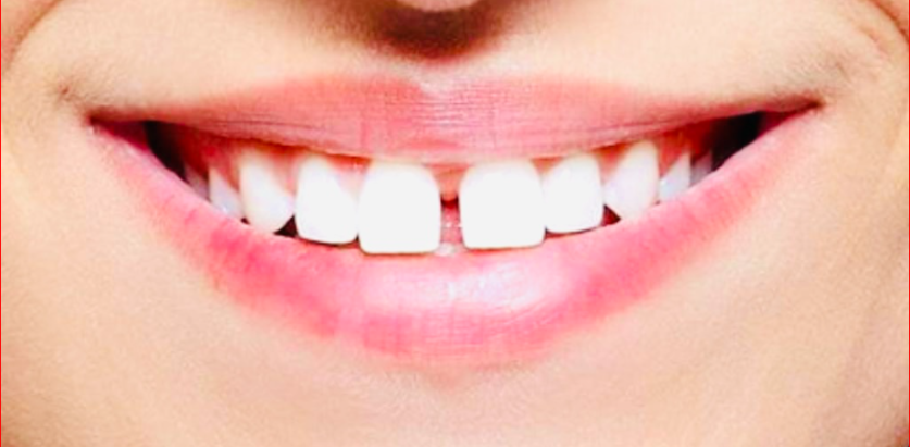 यस्ता ८ विशेषताले भरिपुर्ण हुन्छन् दाँत फट्टीएका व्यक्ति