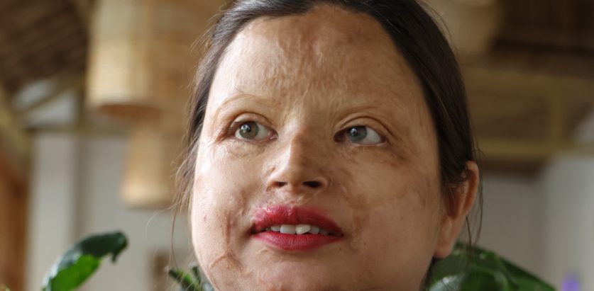 एसिड आक्रमणविरुद्ध छुट्टै कानुन बनाउनुपर्छ : विन्दबासिनी