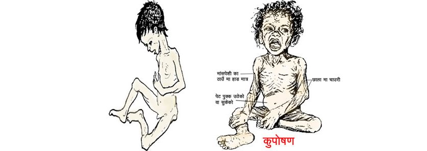 विराटनगरको एउटै वडामा ३३ बालबालिकामा कुपोषण