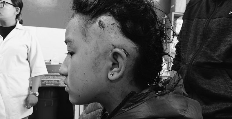 सोलुखुम्बुमा भालुको आक्रमणबाट एक बालिका घाइते