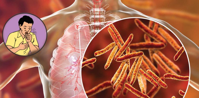 बागलुङका एउटै पालिकामा एकसय ११ क्षयरोगी